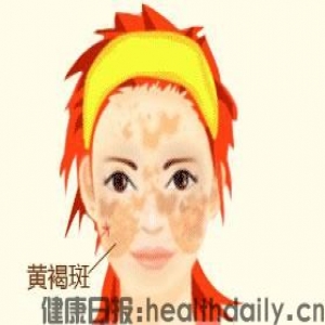 有了黄褐斑不用慌，中医中药来帮忙。